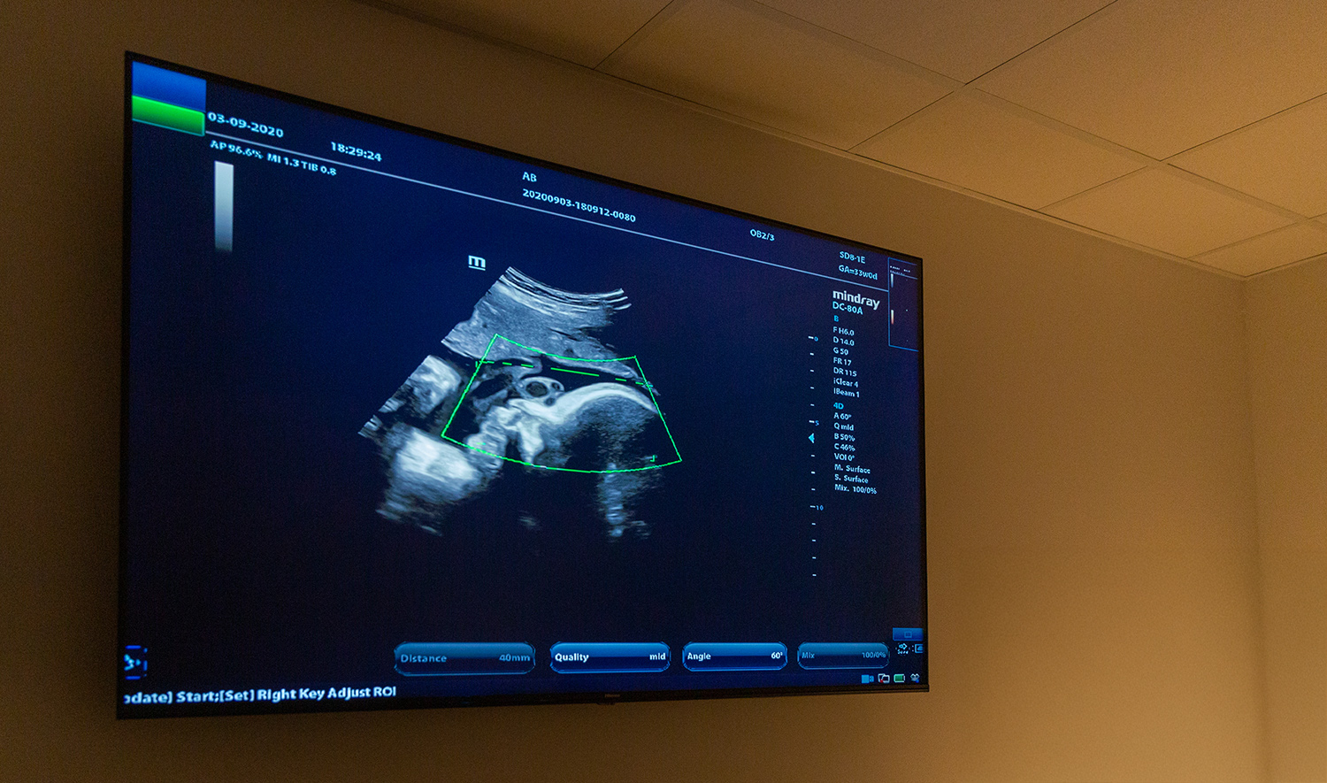 Yorkshire baby scan services